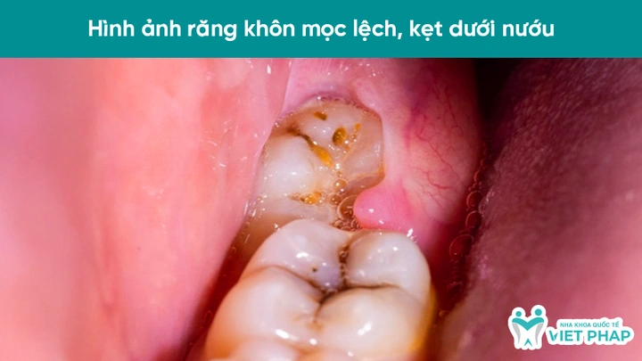 100+ Hình Ảnh Răng Mọc Lệch 2026 - Bộ Sưu Tập Đẹp Nhất, Đầy Đủ Cho Mọi Nhu Cầu? 100+ Hình Ảnh Răng Mọc Lệch 2026 - Bộ Sưu Tập Đẹp Nhất, Đầy Đủ Cho Mọi Nhu Cầu?