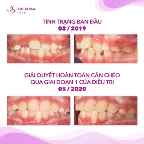 100+ Hình Ảnh Răng Mọc Lệch 2026 - Bộ Sưu Tập Đẹp Nhất, Đầy Đủ Cho Mọi Nhu Cầu? 100+ Hình Ảnh Răng Mọc Lệch 2026 - Bộ Sưu Tập Đẹp Nhất, Đầy Đủ Cho Mọi Nhu Cầu?