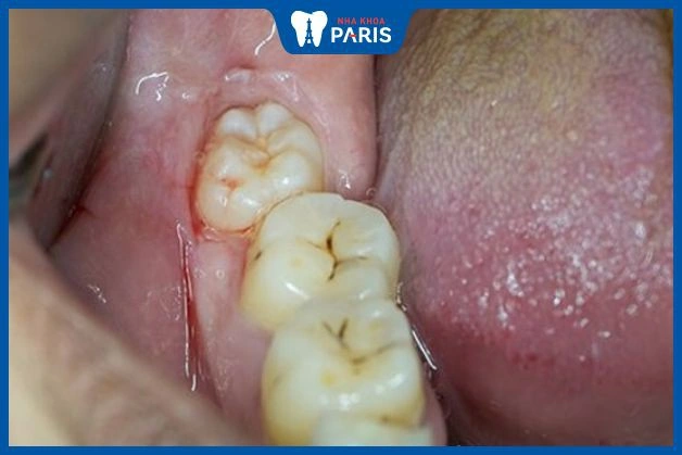 100+ Hình Ảnh Răng Mọc Lệch 2026 - Bộ Sưu Tập Đẹp Nhất, Đầy Đủ Cho Mọi Nhu Cầu? 100+ Hình Ảnh Răng Mọc Lệch 2026 - Bộ Sưu Tập Đẹp Nhất, Đầy Đủ Cho Mọi Nhu Cầu?
