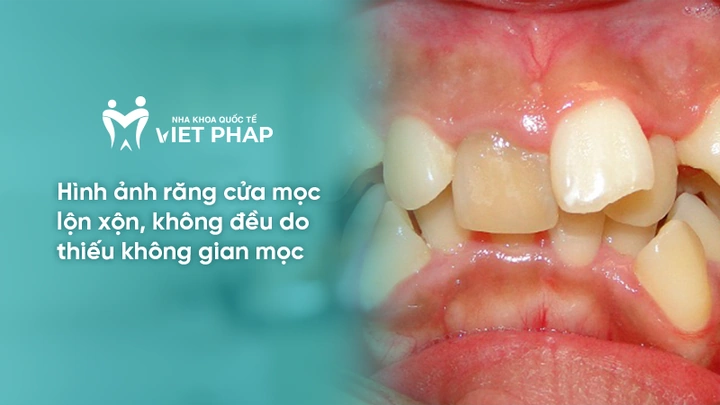 100+ Hình Ảnh Răng Mọc Lệch 2026 - Bộ Sưu Tập Đẹp Nhất, Đầy Đủ Cho Mọi Nhu Cầu? 100+ Hình Ảnh Răng Mọc Lệch 2026 - Bộ Sưu Tập Đẹp Nhất, Đầy Đủ Cho Mọi Nhu Cầu?