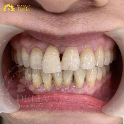 100+ Hình Ảnh Răng Mọc Lệch 2026 - Bộ Sưu Tập Đẹp Nhất, Đầy Đủ Cho Mọi Nhu Cầu? 100+ Hình Ảnh Răng Mọc Lệch 2026 - Bộ Sưu Tập Đẹp Nhất, Đầy Đủ Cho Mọi Nhu Cầu?