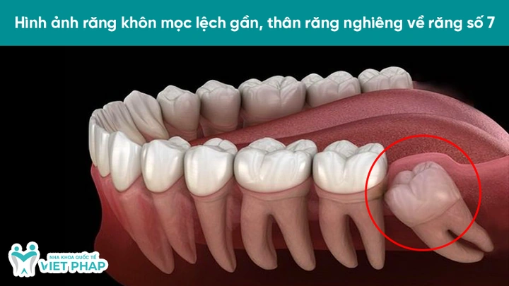 100+ Hình Ảnh Răng Mọc Lệch 2026 - Bộ Sưu Tập Đẹp Nhất, Đầy Đủ Cho Mọi Nhu Cầu? 100+ Hình Ảnh Răng Mọc Lệch 2026 - Bộ Sưu Tập Đẹp Nhất, Đầy Đủ Cho Mọi Nhu Cầu?