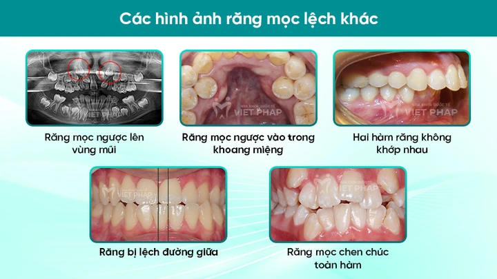 100+ Hình Ảnh Răng Mọc Lệch 2026 - Bộ Sưu Tập Đẹp Nhất, Đầy Đủ Cho Mọi Nhu Cầu? 100+ Hình Ảnh Răng Mọc Lệch 2026 - Bộ Sưu Tập Đẹp Nhất, Đầy Đủ Cho Mọi Nhu Cầu?
