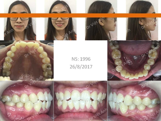 100+ Hình Ảnh Răng Mọc Lệch 2026 - Bộ Sưu Tập Đẹp Nhất, Đầy Đủ Cho Mọi Nhu Cầu? 100+ Hình Ảnh Răng Mọc Lệch 2026 - Bộ Sưu Tập Đẹp Nhất, Đầy Đủ Cho Mọi Nhu Cầu?