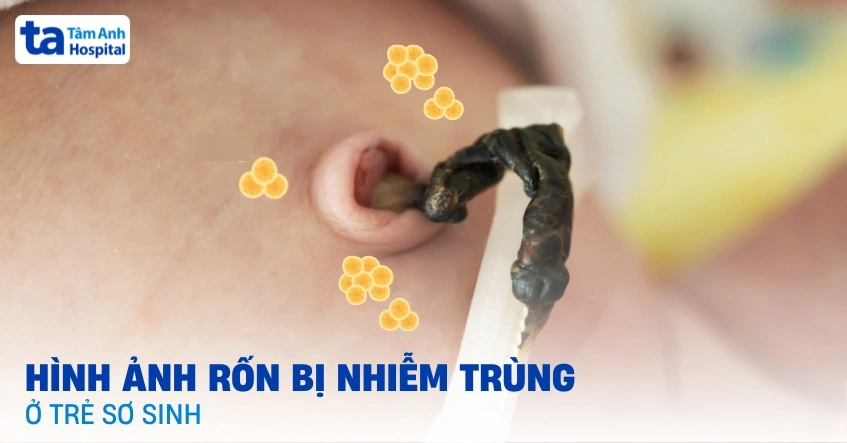 100+ Hình Ảnh Rốn Ngửa 2026 Đẹp Nhất, 100+ Bức Ảnh Rốn Ngửa Đầy Sắc Màu Và Cảm Hứng, 100+ Hình Ảnh Rốn Ngửa Độc Đáo Khiến Bạn Không Thể Rời Mắt