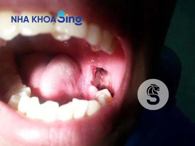Hình Ảnh Sau Khi Nhổ Răng Khôn: Quy Trình Lành, Biến Chứng & Cách Chăm Sóc Nhanh Chóng Cho Bệnh Nhân Hình Ảnh Sau Khi Nhổ Răng Khôn: Quy Trình Lành, Biến Chứng & Cách Chăm Sóc Nhanh Chóng Cho Bệnh Nhân