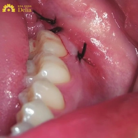 Hình Ảnh Sau Khi Nhổ Răng Khôn: Quy Trình Lành, Biến Chứng & Cách Chăm Sóc Nhanh Chóng Cho Bệnh Nhân Hình Ảnh Sau Khi Nhổ Răng Khôn: Quy Trình Lành, Biến Chứng & Cách Chăm Sóc Nhanh Chóng Cho Bệnh Nhân