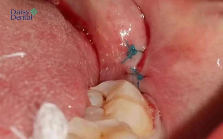 Hình Ảnh Sau Khi Nhổ Răng Khôn: Quy Trình Lành, Biến Chứng & Cách Chăm Sóc Nhanh Chóng Cho Bệnh Nhân Hình Ảnh Sau Khi Nhổ Răng Khôn: Quy Trình Lành, Biến Chứng & Cách Chăm Sóc Nhanh Chóng Cho Bệnh Nhân