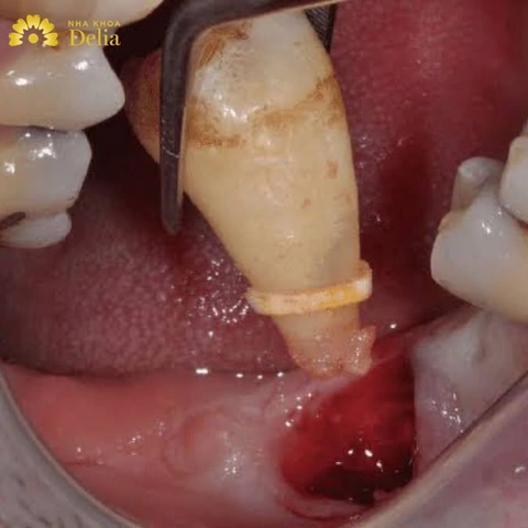 Hình Ảnh Sau Khi Nhổ Răng Khôn: Quy Trình Lành, Biến Chứng & Cách Chăm Sóc Nhanh Chóng Cho Bệnh Nhân Hình Ảnh Sau Khi Nhổ Răng Khôn: Quy Trình Lành, Biến Chứng & Cách Chăm Sóc Nhanh Chóng Cho Bệnh Nhân