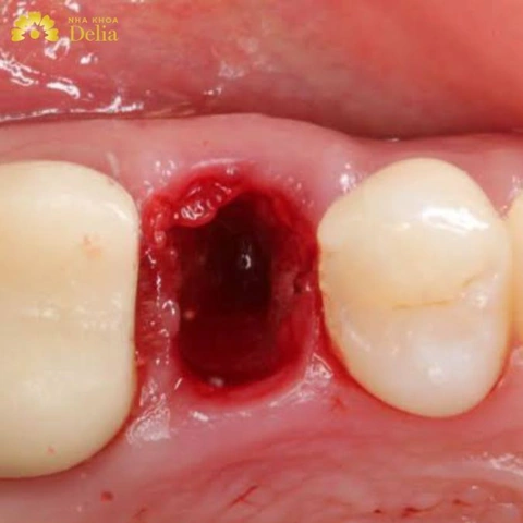 Hình Ảnh Sau Khi Nhổ Răng Khôn: Quy Trình Lành, Biến Chứng & Cách Chăm Sóc Nhanh Chóng Cho Bệnh Nhân Hình Ảnh Sau Khi Nhổ Răng Khôn: Quy Trình Lành, Biến Chứng & Cách Chăm Sóc Nhanh Chóng Cho Bệnh Nhân