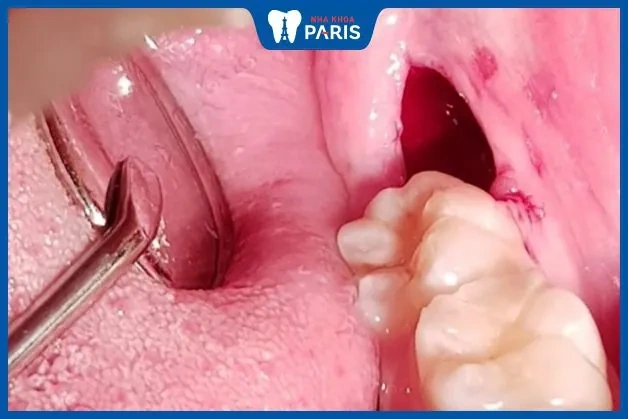 Hình Ảnh Sau Khi Nhổ Răng Khôn: Quy Trình Lành, Biến Chứng & Cách Chăm Sóc Nhanh Chóng Cho Bệnh Nhân Hình Ảnh Sau Khi Nhổ Răng Khôn: Quy Trình Lành, Biến Chứng & Cách Chăm Sóc Nhanh Chóng Cho Bệnh Nhân