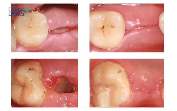 Hình Ảnh Sau Khi Nhổ Răng Khôn: Quy Trình Lành, Biến Chứng & Cách Chăm Sóc Nhanh Chóng Cho Bệnh Nhân Hình Ảnh Sau Khi Nhổ Răng Khôn: Quy Trình Lành, Biến Chứng & Cách Chăm Sóc Nhanh Chóng Cho Bệnh Nhân
