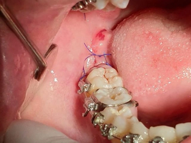 Hình Ảnh Sau Khi Nhổ Răng Khôn: Quy Trình Lành, Biến Chứng & Cách Chăm Sóc Nhanh Chóng Cho Bệnh Nhân Hình Ảnh Sau Khi Nhổ Răng Khôn: Quy Trình Lành, Biến Chứng & Cách Chăm Sóc Nhanh Chóng Cho Bệnh Nhân
