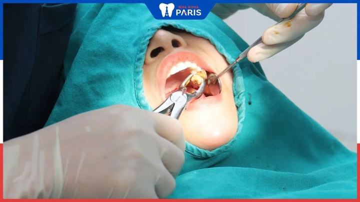 Hình Ảnh Sau Khi Nhổ Răng Khôn: Quy Trình Lành, Biến Chứng & Cách Chăm Sóc Nhanh Chóng Cho Bệnh Nhân Hình Ảnh Sau Khi Nhổ Răng Khôn: Quy Trình Lành, Biến Chứng & Cách Chăm Sóc Nhanh Chóng Cho Bệnh Nhân