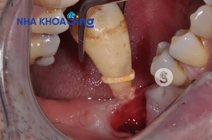 Hình Ảnh Sau Khi Nhổ Răng Khôn: Quy Trình Lành, Biến Chứng & Cách Chăm Sóc Nhanh Chóng Cho Bệnh Nhân Hình Ảnh Sau Khi Nhổ Răng Khôn: Quy Trình Lành, Biến Chứng & Cách Chăm Sóc Nhanh Chóng Cho Bệnh Nhân