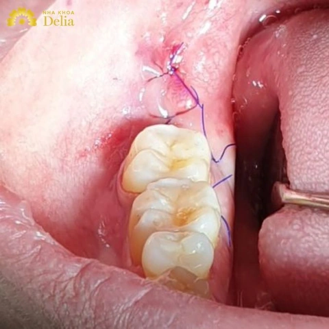 Hình Ảnh Sau Khi Nhổ Răng Khôn: Quy Trình Lành, Biến Chứng & Cách Chăm Sóc Nhanh Chóng Cho Bệnh Nhân Hình Ảnh Sau Khi Nhổ Răng Khôn: Quy Trình Lành, Biến Chứng & Cách Chăm Sóc Nhanh Chóng Cho Bệnh Nhân
