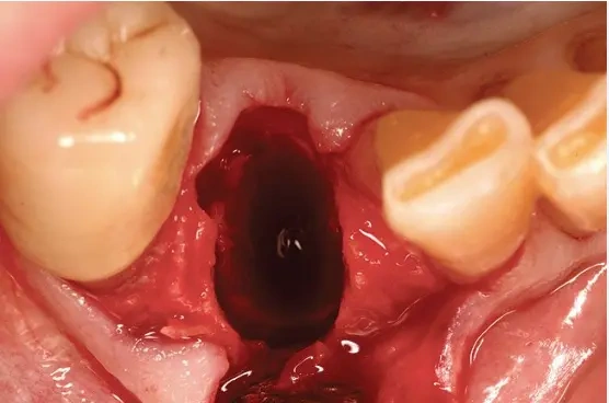 Hình Ảnh Sau Khi Nhổ Răng Khôn: Quy Trình Lành, Biến Chứng & Cách Chăm Sóc Nhanh Chóng Cho Bệnh Nhân Hình Ảnh Sau Khi Nhổ Răng Khôn: Quy Trình Lành, Biến Chứng & Cách Chăm Sóc Nhanh Chóng Cho Bệnh Nhân