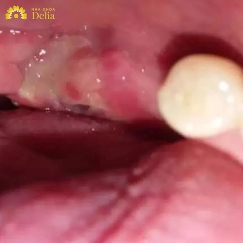 Hình Ảnh Sau Khi Nhổ Răng Khôn: Quy Trình Lành, Biến Chứng & Cách Chăm Sóc Nhanh Chóng Cho Bệnh Nhân Hình Ảnh Sau Khi Nhổ Răng Khôn: Quy Trình Lành, Biến Chứng & Cách Chăm Sóc Nhanh Chóng Cho Bệnh Nhân