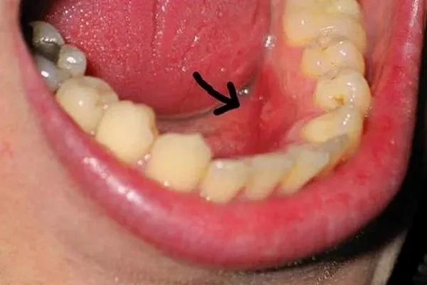 Hình Ảnh Sau Khi Nhổ Răng Khôn: Quy Trình Lành, Biến Chứng & Cách Chăm Sóc Nhanh Chóng Cho Bệnh Nhân Hình Ảnh Sau Khi Nhổ Răng Khôn: Quy Trình Lành, Biến Chứng & Cách Chăm Sóc Nhanh Chóng Cho Bệnh Nhân