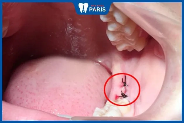 Hình Ảnh Sau Khi Nhổ Răng Khôn: Quy Trình Lành, Biến Chứng & Cách Chăm Sóc Nhanh Chóng Cho Bệnh Nhân Hình Ảnh Sau Khi Nhổ Răng Khôn: Quy Trình Lành, Biến Chứng & Cách Chăm Sóc Nhanh Chóng Cho Bệnh Nhân