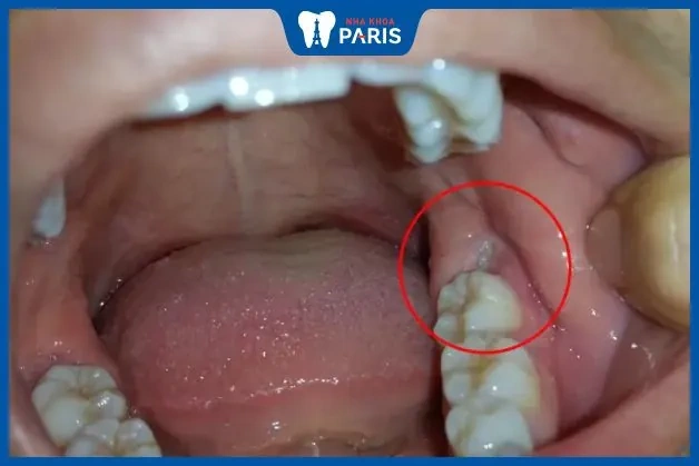 Hình Ảnh Sau Khi Nhổ Răng Khôn: Quy Trình Lành, Biến Chứng & Cách Chăm Sóc Nhanh Chóng Cho Bệnh Nhân Hình Ảnh Sau Khi Nhổ Răng Khôn: Quy Trình Lành, Biến Chứng & Cách Chăm Sóc Nhanh Chóng Cho Bệnh Nhân