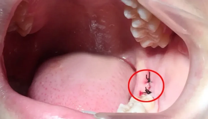Hình Ảnh Sau Khi Nhổ Răng Khôn: Quy Trình Lành, Biến Chứng & Cách Chăm Sóc Nhanh Chóng Cho Bệnh Nhân Hình Ảnh Sau Khi Nhổ Răng Khôn: Quy Trình Lành, Biến Chứng & Cách Chăm Sóc Nhanh Chóng Cho Bệnh Nhân