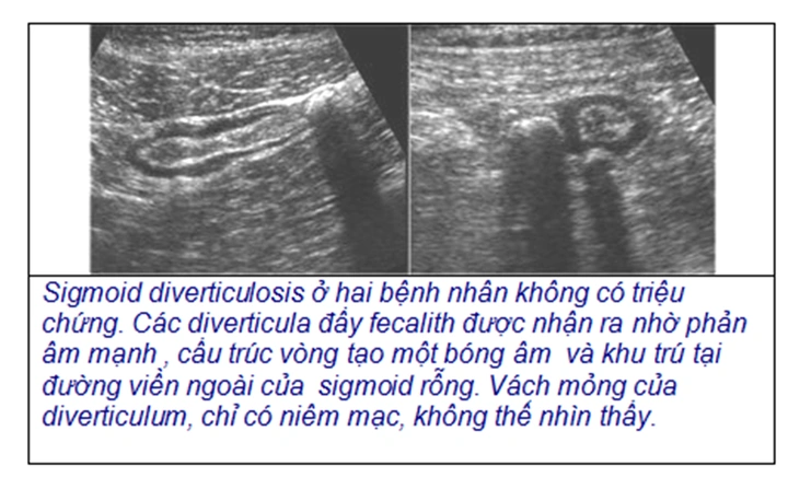 Hình Ảnh Siêu Âm Viêm Ruột Thừa: Cách Đọc, Chuẩn Đoán Và Lưu Ý Cho Bác Sĩ & Bệnh Nhân Hình Ảnh Siêu Âm Viêm Ruột Thừa: Cách Đọc, Chuẩn Đoán Và Lưu Ý Cho Bác Sĩ & Bệnh Nhân