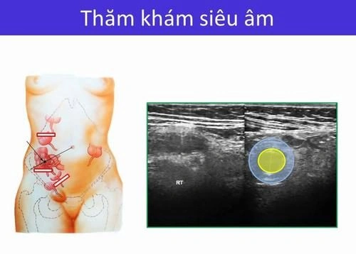 Hình Ảnh Siêu Âm Viêm Ruột Thừa: Cách Đọc, Chuẩn Đoán Và Lưu Ý Cho Bác Sĩ & Bệnh Nhân Hình Ảnh Siêu Âm Viêm Ruột Thừa: Cách Đọc, Chuẩn Đoán Và Lưu Ý Cho Bác Sĩ & Bệnh Nhân