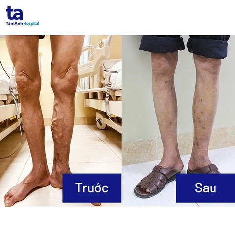 100+ Hình Ảnh Tiêm Tĩnh Mạch 4k Đẹp Nhất 2026, 100+ Bức Ảnh Chất Lượng Cao Cho Mọi Nhu Cầu?