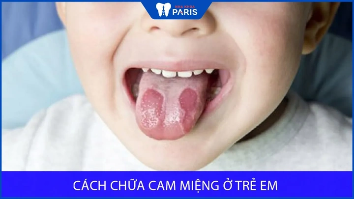 Hình Ảnh Trẻ Bị Cam Miệng: Dấu Hiệu Nhận Biết, Nguyên Nhân Và Cách Điều Trị Hiệu Quả Hình Ảnh Trẻ Bị Cam Miệng: Dấu Hiệu Nhận Biết, Nguyên Nhân Và Cách Điều Trị Hiệu Quả