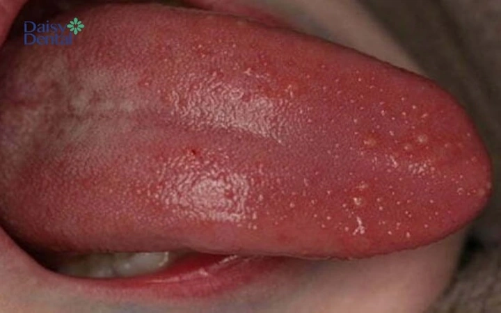Hình Ảnh Trẻ Bị Cam Miệng: Dấu Hiệu Nhận Biết, Nguyên Nhân Và Cách Điều Trị Hiệu Quả Hình Ảnh Trẻ Bị Cam Miệng: Dấu Hiệu Nhận Biết, Nguyên Nhân Và Cách Điều Trị Hiệu Quả
