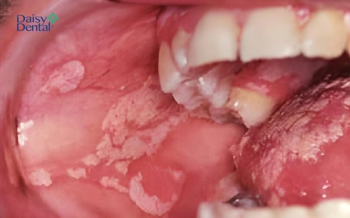 Hình Ảnh Trẻ Bị Cam Miệng: Dấu Hiệu Nhận Biết, Nguyên Nhân Và Cách Điều Trị Hiệu Quả Hình Ảnh Trẻ Bị Cam Miệng: Dấu Hiệu Nhận Biết, Nguyên Nhân Và Cách Điều Trị Hiệu Quả