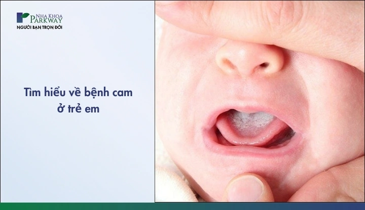 Hình Ảnh Trẻ Bị Cam Miệng: Dấu Hiệu Nhận Biết, Nguyên Nhân Và Cách Điều Trị Hiệu Quả Hình Ảnh Trẻ Bị Cam Miệng: Dấu Hiệu Nhận Biết, Nguyên Nhân Và Cách Điều Trị Hiệu Quả