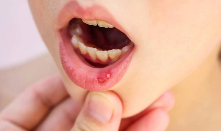 Hình Ảnh Trẻ Bị Cam Miệng: Dấu Hiệu Nhận Biết, Nguyên Nhân Và Cách Điều Trị Hiệu Quả Hình Ảnh Trẻ Bị Cam Miệng: Dấu Hiệu Nhận Biết, Nguyên Nhân Và Cách Điều Trị Hiệu Quả