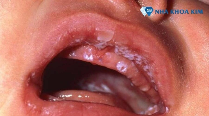 Hình Ảnh Trẻ Bị Cam Miệng: Dấu Hiệu Nhận Biết, Nguyên Nhân Và Cách Điều Trị Hiệu Quả Hình Ảnh Trẻ Bị Cam Miệng: Dấu Hiệu Nhận Biết, Nguyên Nhân Và Cách Điều Trị Hiệu Quả
