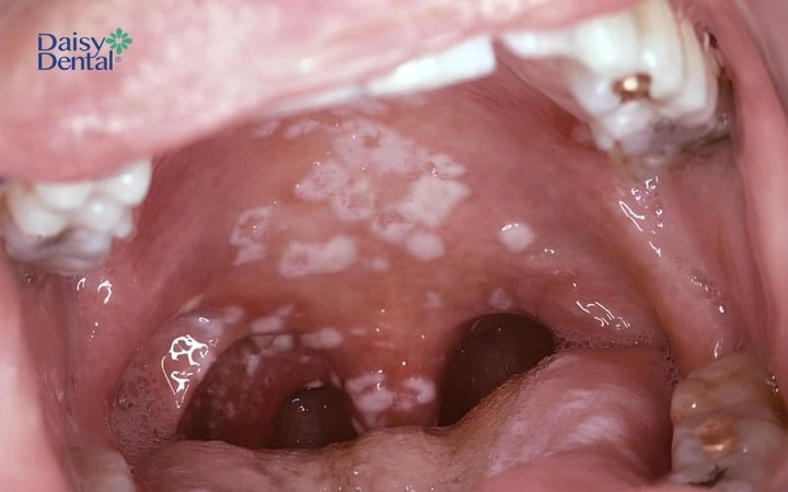 Hình Ảnh Trẻ Bị Cam Miệng: Dấu Hiệu Nhận Biết, Nguyên Nhân Và Cách Điều Trị Hiệu Quả Hình Ảnh Trẻ Bị Cam Miệng: Dấu Hiệu Nhận Biết, Nguyên Nhân Và Cách Điều Trị Hiệu Quả