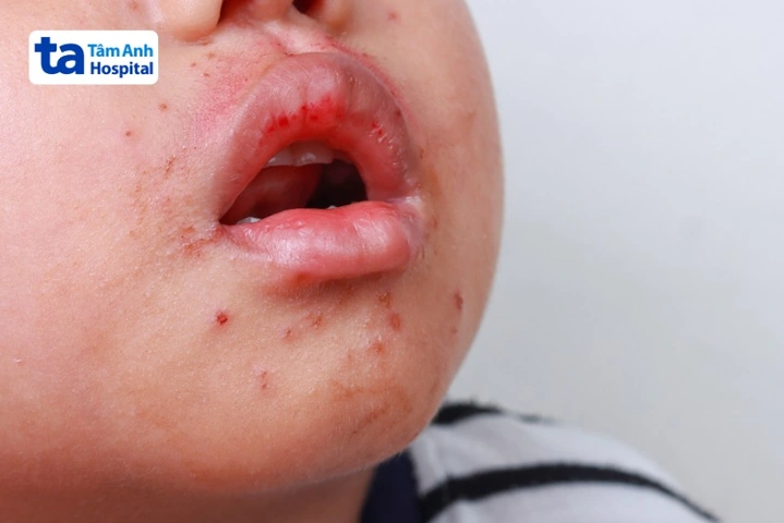 Hình Ảnh Trẻ Bị Cam Miệng: Dấu Hiệu Nhận Biết, Nguyên Nhân Và Cách Điều Trị Hiệu Quả Hình Ảnh Trẻ Bị Cam Miệng: Dấu Hiệu Nhận Biết, Nguyên Nhân Và Cách Điều Trị Hiệu Quả