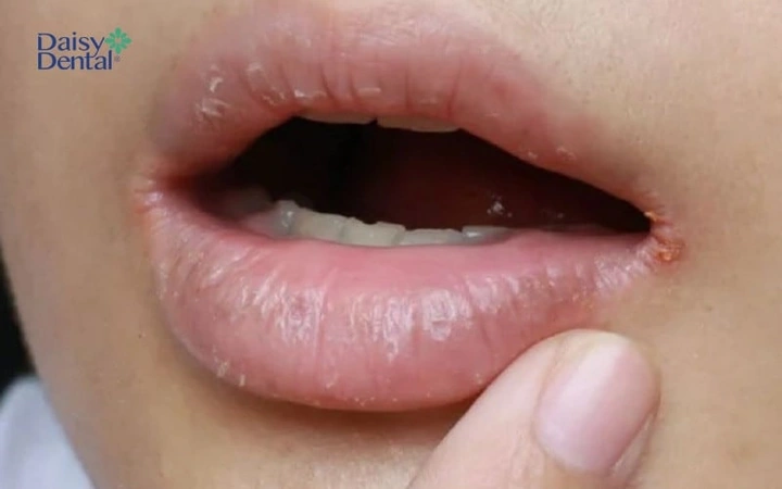 Hình Ảnh Trẻ Bị Cam Miệng: Dấu Hiệu Nhận Biết, Nguyên Nhân Và Cách Điều Trị Hiệu Quả Hình Ảnh Trẻ Bị Cam Miệng: Dấu Hiệu Nhận Biết, Nguyên Nhân Và Cách Điều Trị Hiệu Quả