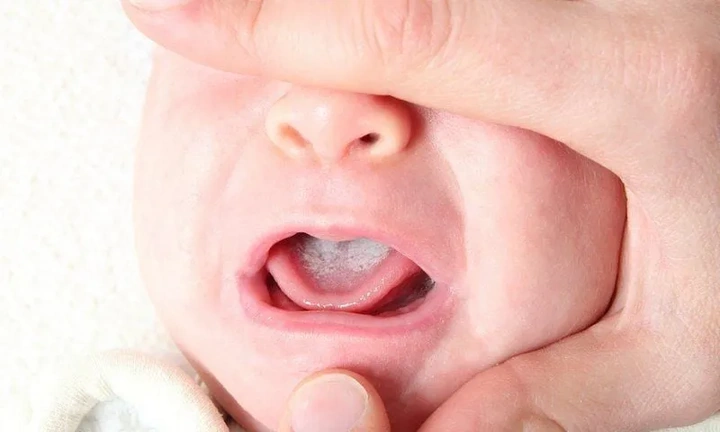 Hình Ảnh Trẻ Bị Cam Miệng: Dấu Hiệu Nhận Biết, Nguyên Nhân Và Cách Điều Trị Hiệu Quả Hình Ảnh Trẻ Bị Cam Miệng: Dấu Hiệu Nhận Biết, Nguyên Nhân Và Cách Điều Trị Hiệu Quả