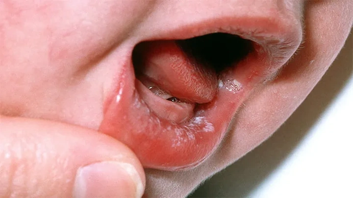 Hình Ảnh Trẻ Bị Cam Miệng: Dấu Hiệu Nhận Biết, Nguyên Nhân Và Cách Điều Trị Hiệu Quả Hình Ảnh Trẻ Bị Cam Miệng: Dấu Hiệu Nhận Biết, Nguyên Nhân Và Cách Điều Trị Hiệu Quả