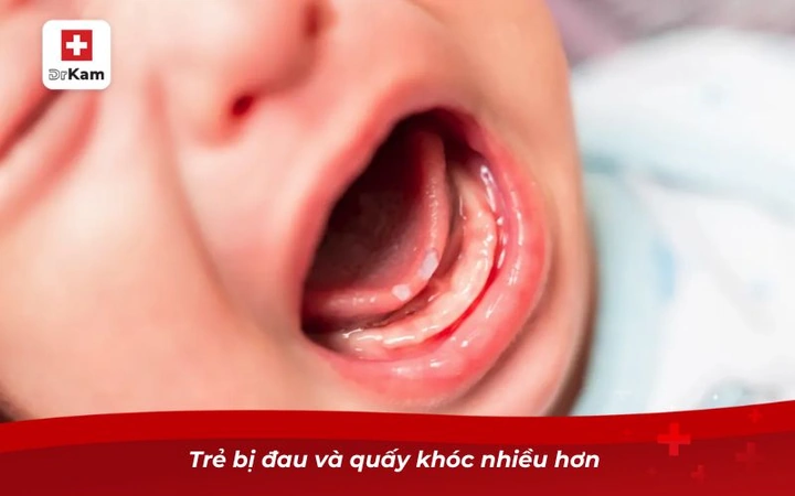 Hình Ảnh Trẻ Bị Cam Miệng: Dấu Hiệu Nhận Biết, Nguyên Nhân Và Cách Điều Trị Hiệu Quả Hình Ảnh Trẻ Bị Cam Miệng: Dấu Hiệu Nhận Biết, Nguyên Nhân Và Cách Điều Trị Hiệu Quả