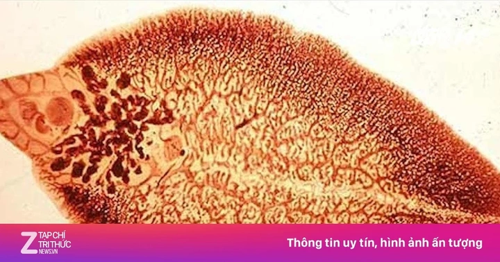 Xem Hình Ảnh Trứng Sán Lá Phổi: Đặc Điểm Nhận Dạng Và Ý Nghĩa Chẩn Đoán Xem Hình Ảnh Trứng Sán Lá Phổi: Đặc Điểm Nhận Dạng Và Ý Nghĩa Chẩn Đoán