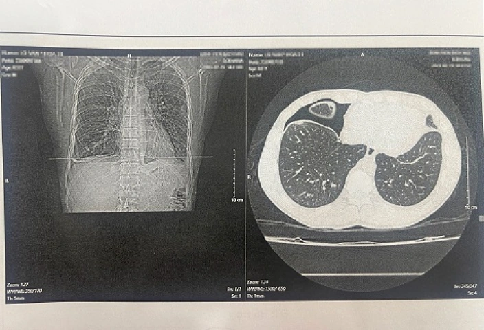 Xem Hình Ảnh Trứng Sán Lá Phổi: Đặc Điểm Nhận Dạng Và Ý Nghĩa Chẩn Đoán Xem Hình Ảnh Trứng Sán Lá Phổi: Đặc Điểm Nhận Dạng Và Ý Nghĩa Chẩn Đoán