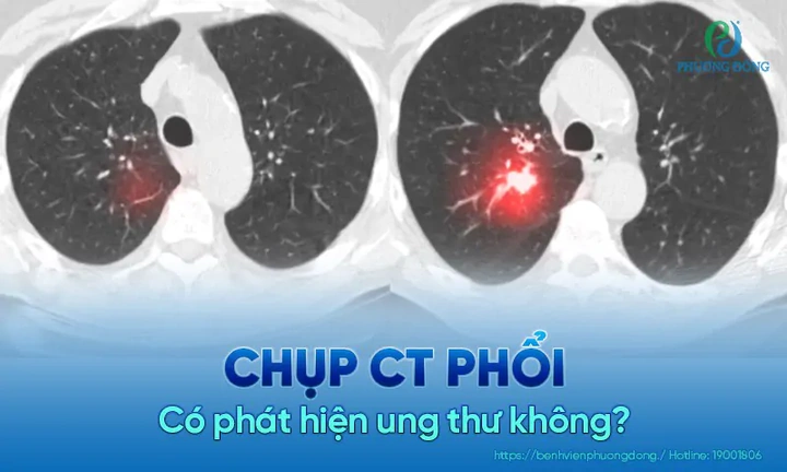 Nhận Diện Hình Ảnh U Phổi Trên Ct: Đặc Điểm, Dấu Hiệu Và Cách Đọc Kết Quả Chẩn Đoán Nhận Diện Hình Ảnh U Phổi Trên Ct: Đặc Điểm, Dấu Hiệu Và Cách Đọc Kết Quả Chẩn Đoán
