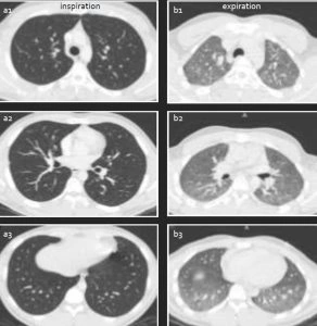 Nhận Diện Hình Ảnh U Phổi Trên Ct: Đặc Điểm, Dấu Hiệu Và Cách Đọc Kết Quả Chẩn Đoán Nhận Diện Hình Ảnh U Phổi Trên Ct: Đặc Điểm, Dấu Hiệu Và Cách Đọc Kết Quả Chẩn Đoán