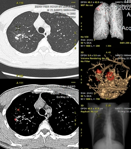 Nhận Diện Hình Ảnh U Phổi Trên Ct: Đặc Điểm, Dấu Hiệu Và Cách Đọc Kết Quả Chẩn Đoán Nhận Diện Hình Ảnh U Phổi Trên Ct: Đặc Điểm, Dấu Hiệu Và Cách Đọc Kết Quả Chẩn Đoán