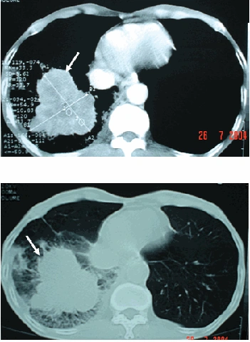 Nhận Diện Hình Ảnh U Phổi Trên Ct: Đặc Điểm, Dấu Hiệu Và Cách Đọc Kết Quả Chẩn Đoán Nhận Diện Hình Ảnh U Phổi Trên Ct: Đặc Điểm, Dấu Hiệu Và Cách Đọc Kết Quả Chẩn Đoán