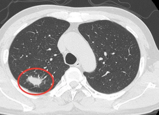 Nhận Diện Hình Ảnh U Phổi Trên Ct: Đặc Điểm, Dấu Hiệu Và Cách Đọc Kết Quả Chẩn Đoán Nhận Diện Hình Ảnh U Phổi Trên Ct: Đặc Điểm, Dấu Hiệu Và Cách Đọc Kết Quả Chẩn Đoán