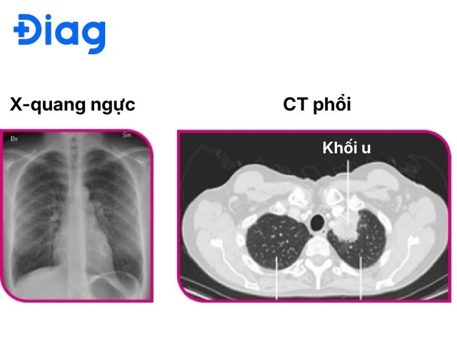 Nhận Diện Hình Ảnh U Phổi Trên Ct: Đặc Điểm, Dấu Hiệu Và Cách Đọc Kết Quả Chẩn Đoán Nhận Diện Hình Ảnh U Phổi Trên Ct: Đặc Điểm, Dấu Hiệu Và Cách Đọc Kết Quả Chẩn Đoán