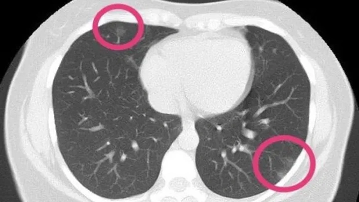 Nhận Diện Hình Ảnh U Phổi Trên Ct: Đặc Điểm, Dấu Hiệu Và Cách Đọc Kết Quả Chẩn Đoán Nhận Diện Hình Ảnh U Phổi Trên Ct: Đặc Điểm, Dấu Hiệu Và Cách Đọc Kết Quả Chẩn Đoán